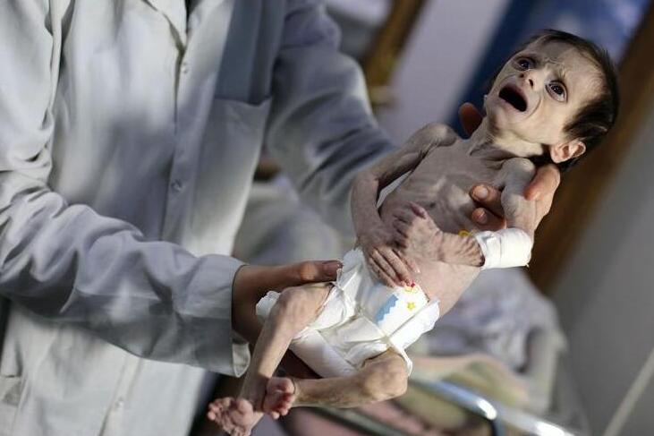 叙利亚战区新生儿:营养不良骨瘦如柴