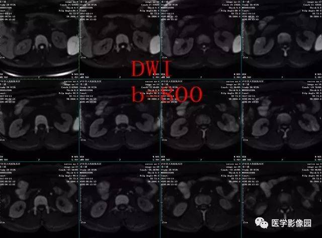 双肾多发结节样异常信号，等你分析丨读片专栏662期