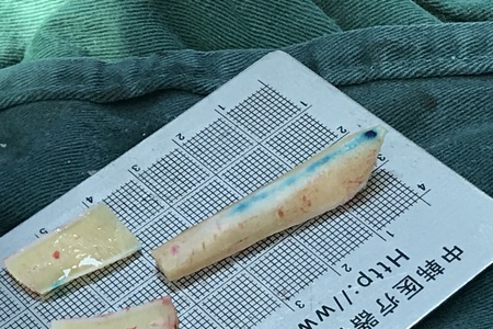 【视频揭秘】卢丙仑教授肋软骨雕刻神技