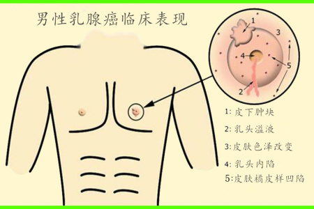 王永春医师访谈   男性乳房肥大就必须切掉吗?答案是.