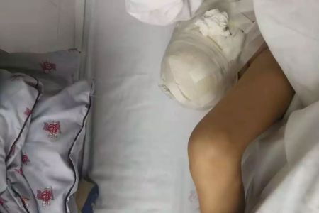 心疼!徐医附院的这个女孩还是截肢了,就在她过10岁生日的前一天