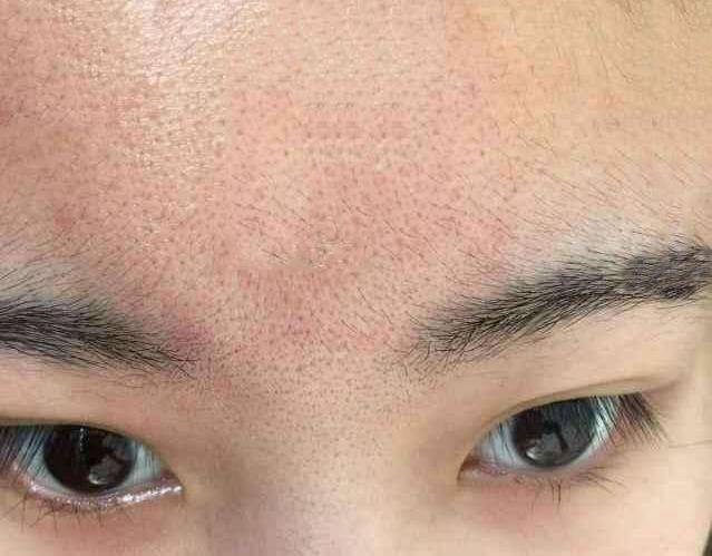 城野医生没办法拯救毛孔粗大 只能靠医美？