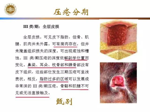 压疮预防与临床实践