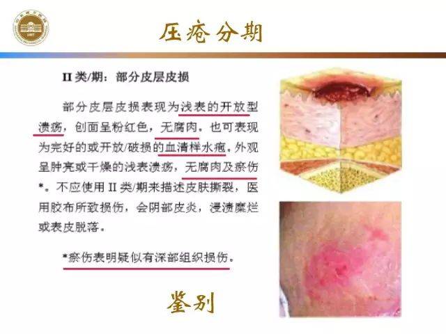 压疮预防与临床实践