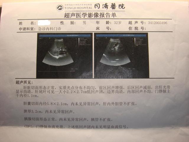 肝右叶内见一个实质性稍强回声区是不是肝血管