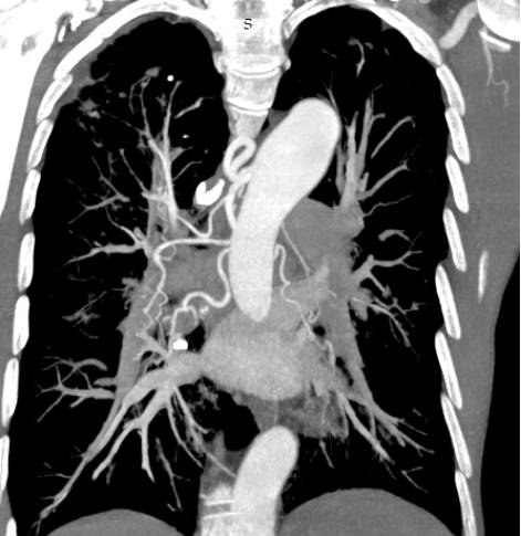 许荆棘:Documents肺栓塞的CTPA诊断
