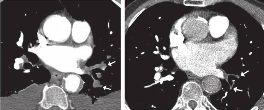 ▼evolution of chronic occlusive pulmonary thromboembolism from