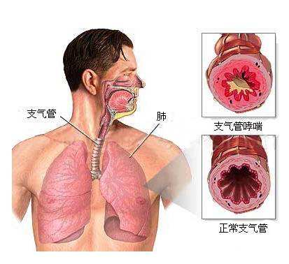 伴有哮鸣音的呼气性呼吸困难(4)支气管哮喘第一秒用力呼气容积占用力