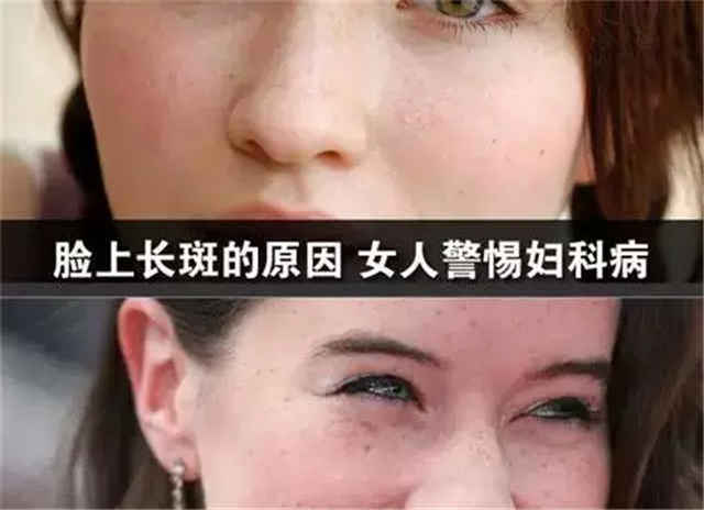 女人脸上长斑,就要小心妇科疾病!