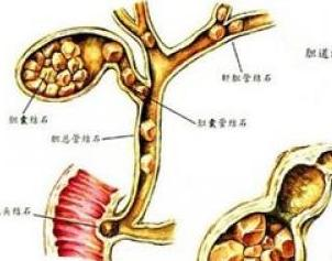 思通克林科普:胆囊结石的症状是什么 上腹疼痛吗