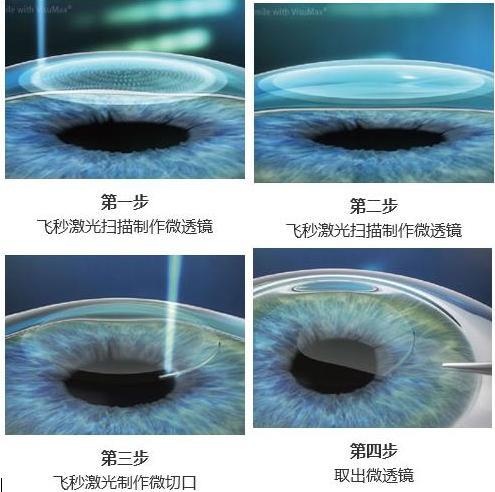 全飞秒近视手术的原理_全飞秒(2)