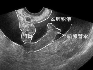 查体发现盆腔积液怎样处理?盆腔积液是盆腔炎吗?