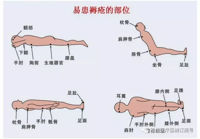 长期卧床病人如何预防褥疮?