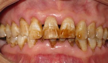 地方性氟中毒也是氟斑牙的成因之一.