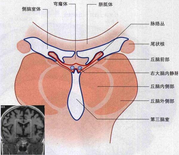 这是一种因脑室颞角流出道梗阻,颞角脉络丛持续分泌脑脊液而造成的