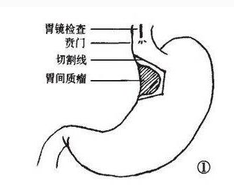 胃间质瘤的症状和胃癌如何区分?健康