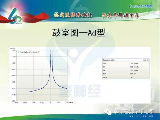 等as型:听骨链骨性固定或镫骨底板固定等(正常人也可见)b型:鼓室积液