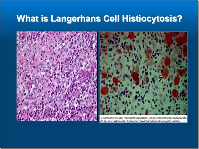 什么是朗格罕细胞组织细胞增生症