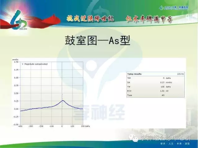 等as型:听骨链骨性固定或镫骨底板固定等(正常人也可见)b型:鼓室积液