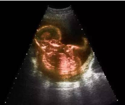 怀孕五个月做五次b超对胎儿有影响吗