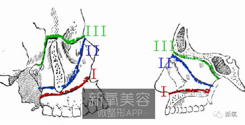 蓝线为lefort ii型截骨,绿线为lefort iii型截骨.