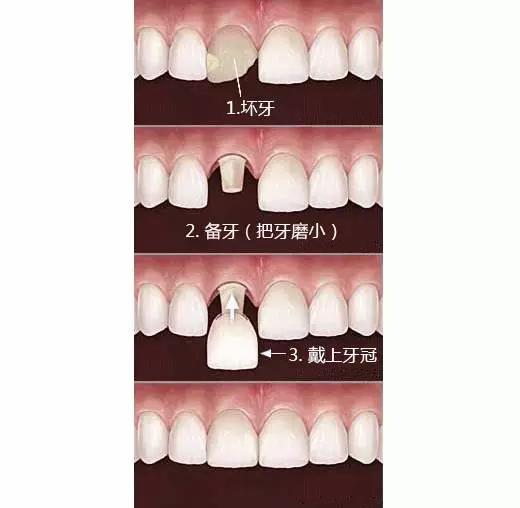 刘涛做了三次"美容冠"!这种牙齿美容真有效吗?