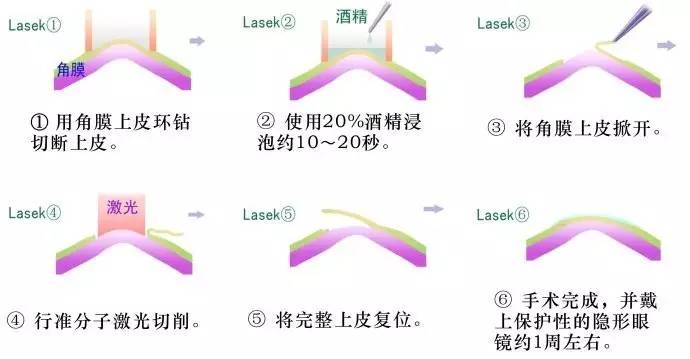 近视镜是运用什么原理_幸福是什么图片