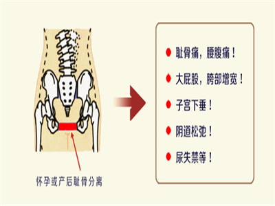 如何避免产后耻骨联合分离?