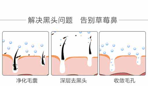 痤疮的形成原理示意图_痤疮形成阶段示意图(3)