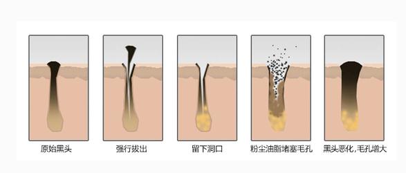 黑头挤出来的是什么东西,螨虫?