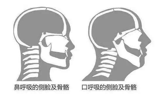 如果这些症状持续发生,还可能导致一些可怕的行为习惯,比如改"鼻呼吸"