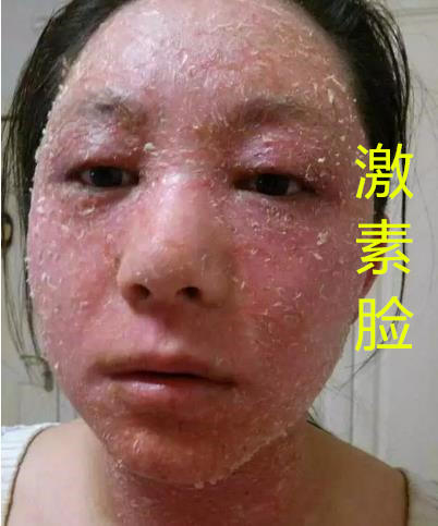 如果是由于过敏,病变或接触什么没有以前接触的东西导致皮肤突然脱皮