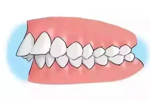 虎牙 2,牙齿咬合有障碍.比如反颌,覆盖咬合,磨牙等等.