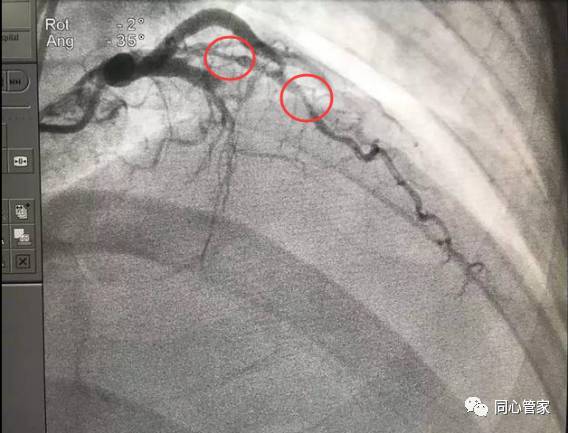 堵塞的血管在冠脉造影下的样子
