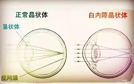 眼睛有发胀,干涩,视力剧烈下降,散光度数剧烈上升,雾视,视物变形