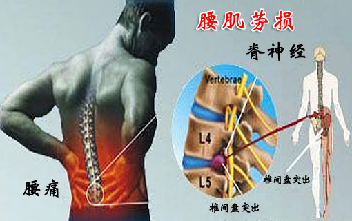 久坐办公室,腰肌劳损怎么办?