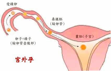 经常做这3件事的女人,宫外孕的概率比常人高一倍