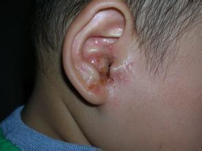 以上便是外耳湿疹的预防方法,要是真的患有外耳湿疹的患者可以用儿童