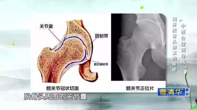 首先,一定要松解股骨头周围的关节囊以及韧带,否则修复的功能达不到