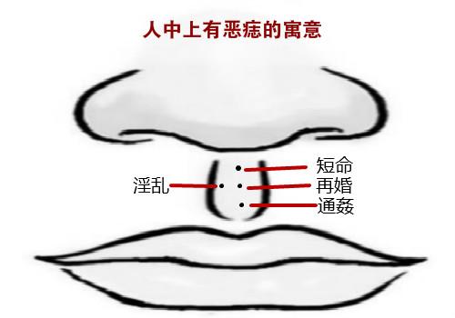 痣相篇:详细解析人中痣的吉凶寓意