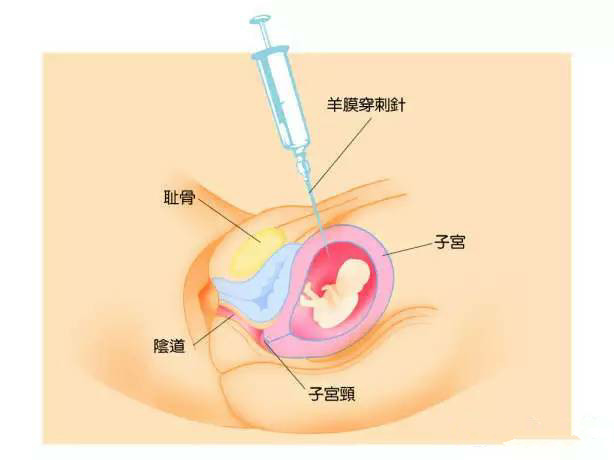 羊水穿刺的最佳时间是什么时候