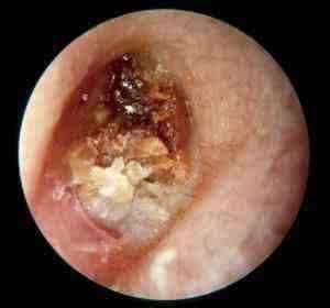 答:造成耳痛的问题可能有:耵聍(耳垢)栓塞,耳道急性感染,耳模急性感染
