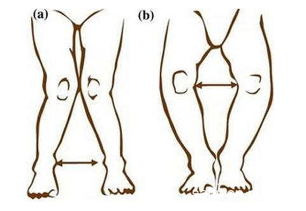 过度矫正反而会可能会变为"x型腿"