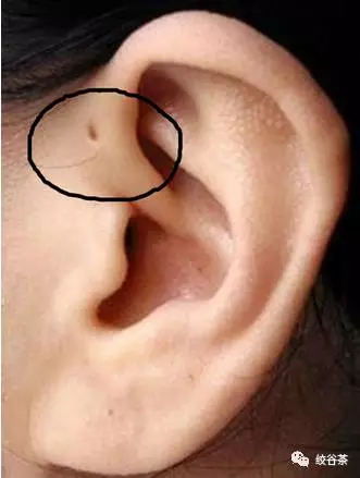 这可不是女孩子贪图好看给耳朵上打的耳洞,它的学名叫做"耳前瘘管"