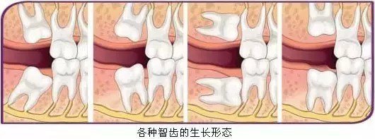 大多数人智齿都是歪的和前牙之间出现一道沟不塞才怪~摘要:别拿塞牙