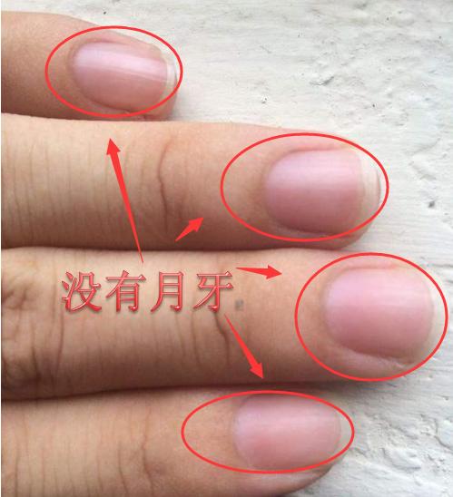 你手指上有月牙白/痕吗?它能反映你是否健康?