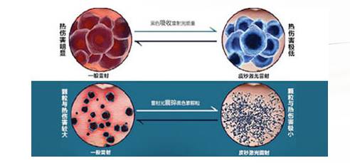激光去斑什么原理_激光去斑(2)