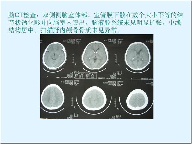 结节性硬化症