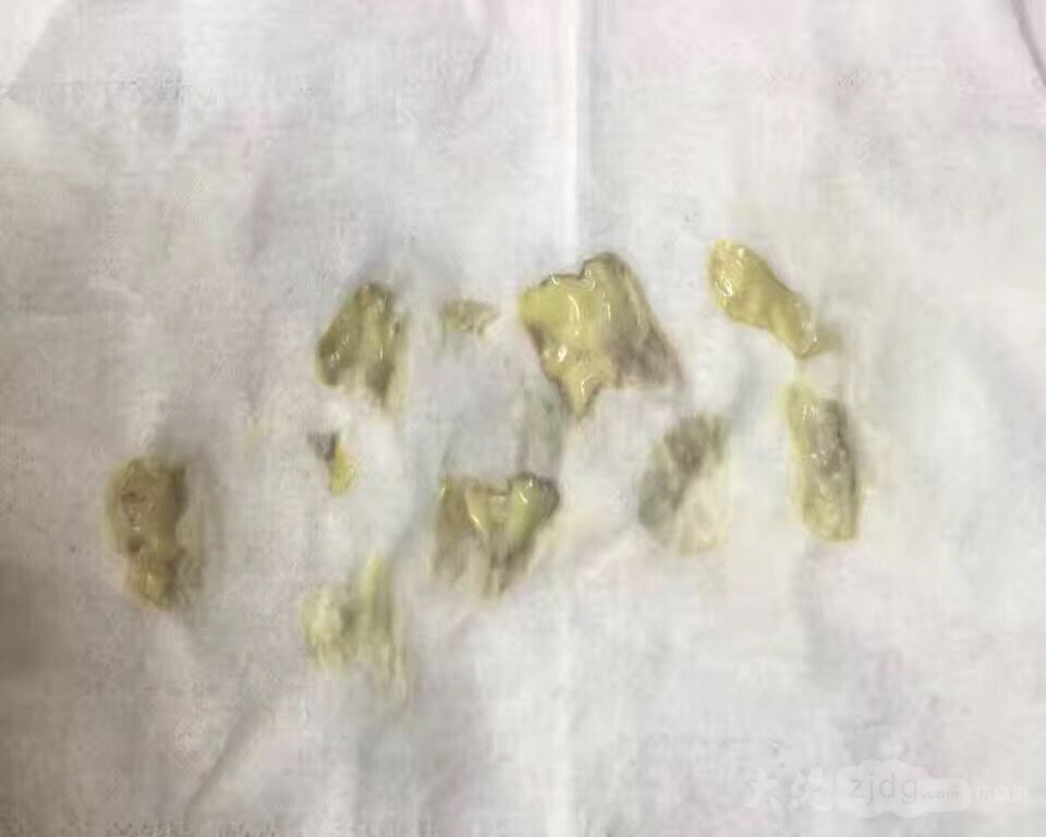 这种说法是没有科学依据的,目前没有任何一家权威机构证实,不排残奶