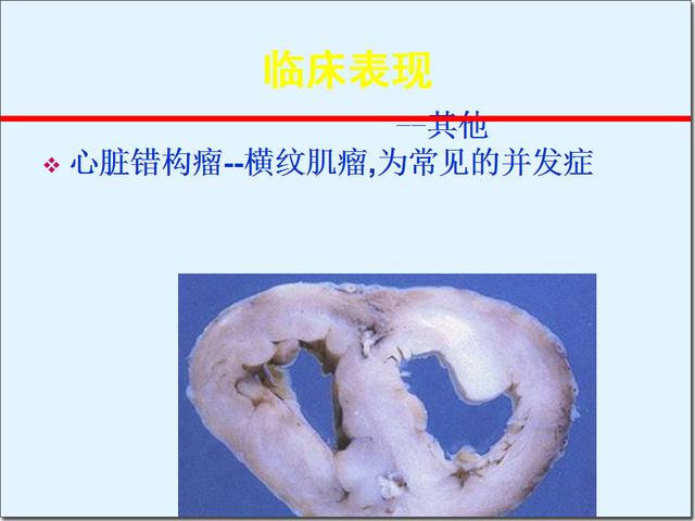 结节性硬化症